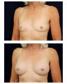 Breast Augmentation