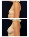 Breast Augmentation