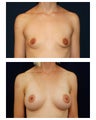 Breast Augmentation