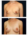 Breast Augmentation