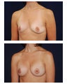 Breast Augmentation