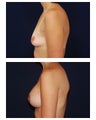 Breast Augmentation