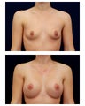Breast Augmentation