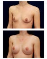 Breast Augmentation