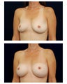 Breast Augmentation