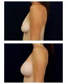 Breast Augmentation