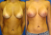 Breast Augmentation