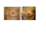 Breast Augmentation