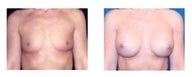 Breast Augmentation
