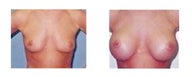 Breast Augmentation/Breast Implants 