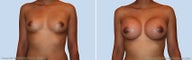 Breast Augmentation