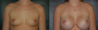 Breast Augmentation
