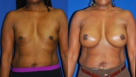 Breast reconstruction with tissue expanders followed by 700cc high profile submuscular silicone augmentation