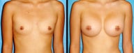 Breast Augmentation