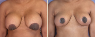 Breast Implant Removal