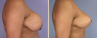 Breast Implant Removal