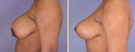 Breast Implant Removal