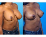 Breast Implant Removal and Replacement