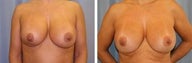45 years old / revision breast augmentation Silicone moderate plus profile 700cc's left and 752cc's right side.