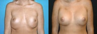Breast Revision/Correction - Double Bubble Deformity