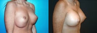 Breast Revision/Correction - Double Bubble Deformity