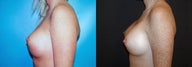 Breast Revision/Correction - Double Bubble Deformity
