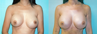Large Breast Implant Revision/Revision