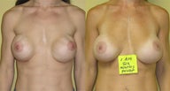 Revision Breast Augmentation