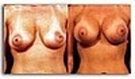 Breast Implant Revision