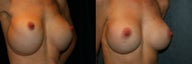 Breast Implant Revision