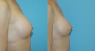 Correction of Capsular Contracture with 410 implants