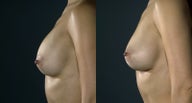 Correction of Capsular Contracture with 410 implants