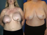 Breast Revision