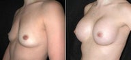 Breast Augmentation