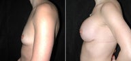 Breast Augmentation