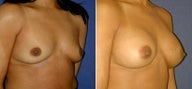 Breast Augmentation