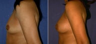 Breast Augmentation
