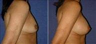 Breast Augmentation