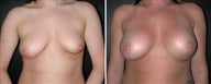 Breast Augmentation
