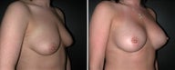 Breast Augmentation