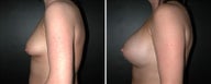 Breast Augmentation 