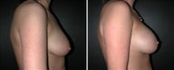 Breast Augmentation