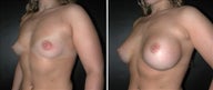 Breast Augmentation