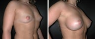 Breast Augmentation