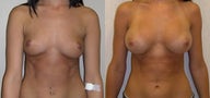 Breast augment
