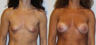 Breast Augmentation