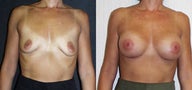 Breast augment