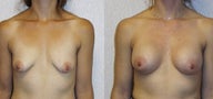 Breast augment