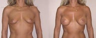 Breast augment