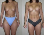 Liposuction and breast augmentation
